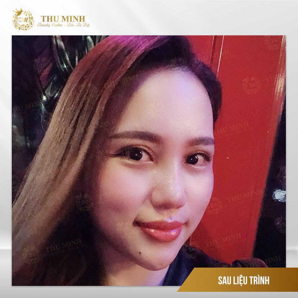 Thu gọn cánh mũi cho dáng mũi thon gọn, đẹp tự nhiên